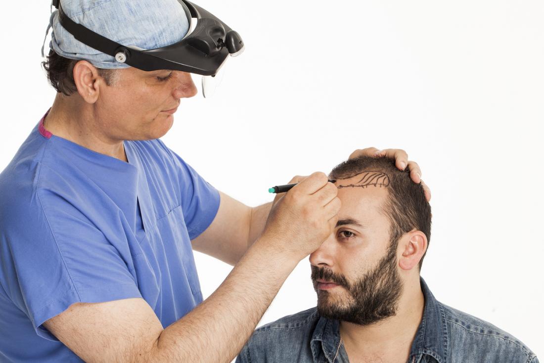Best Ways To Find The Top Hair Transplant Clinic In Jaipur?